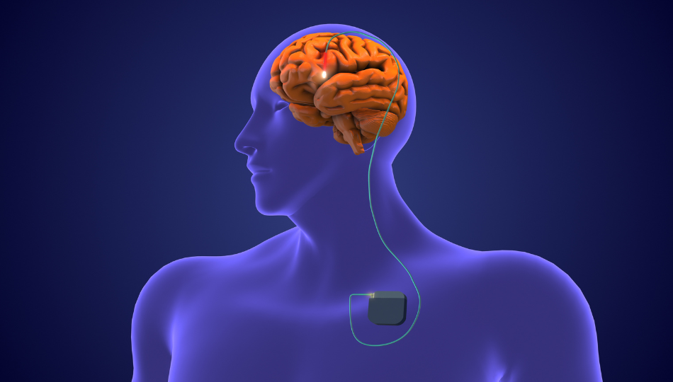 Seven Things to Know About Recovering from Deep Brain Stimulation Surgery
